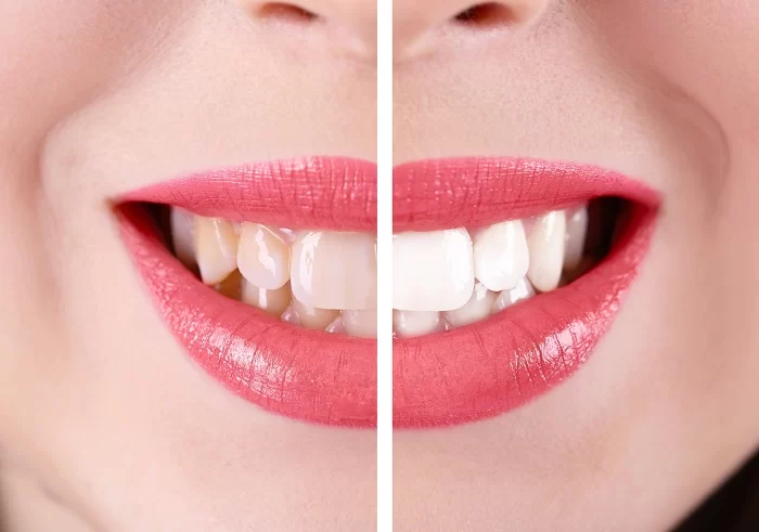 Dents jaunes : Les conseils naturels s’en débarasser